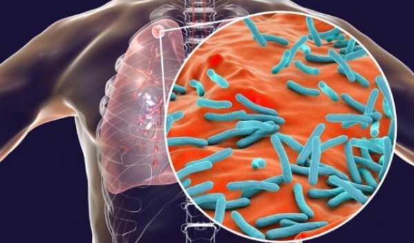 The highest number of tuberculosis cases in the US in the last ten years